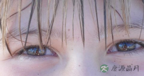 视力矫正手术后注意事项