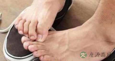 脚感染真菌不能吃什么