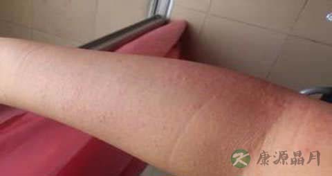 荨麻疹不能吃什么
