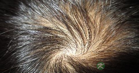 遗传脱发原因及治疗