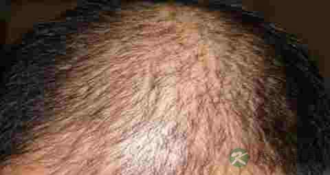 如何治疗脂溢性脱发