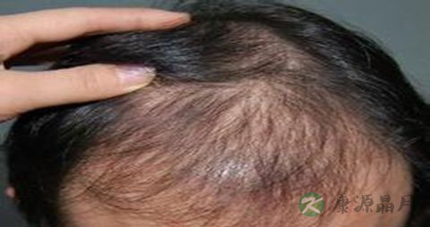 男人脱发用什么洗发水 男人脱发用什么洗发水