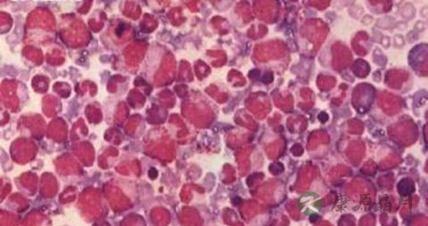 骨髓增生异常综合征饮食注意 骨髓增生异常综合征饮食注意