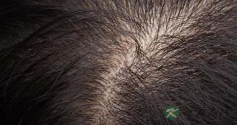 头发稀少吃什么 头发稀少吃什么