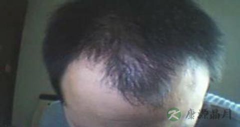 有什么方法治疗脱发 有什么方法治疗脱发