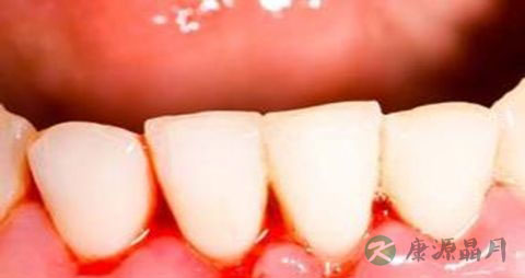 牙龈上火应该吃什么 牙龈上火应该吃什么