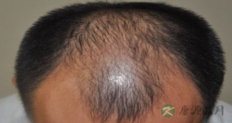 失眠脱发怎么办