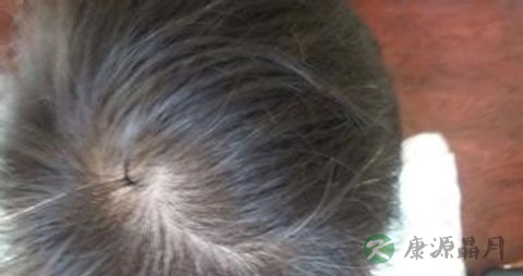 脱发特别严重怎么办 脱发特别严重怎么办