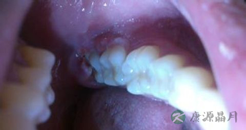 牙齿发炎吃什么食物