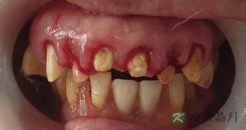 牙龈萎缩吃什么 牙龈萎缩吃什么
