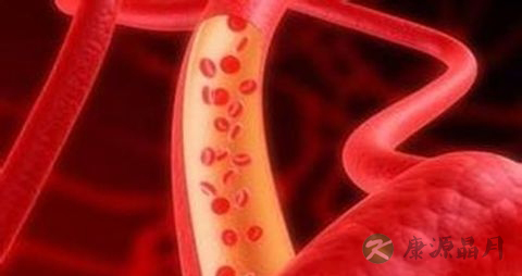 血栓适合吃什么 血栓适合吃什么