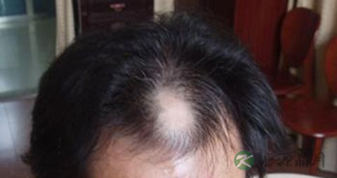 肾虚脱发还会长头发吗