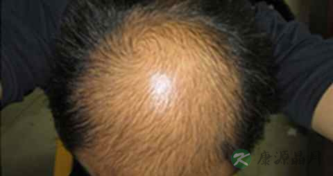 男人为什么会脱发 男人为什么会脱发