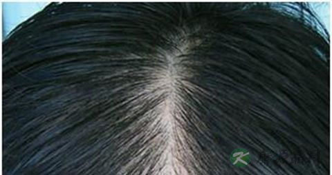 脂溢性脱发用什么洗头 脂溢性脱发用什么洗头