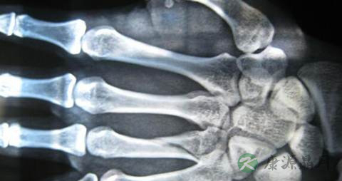 手骨头断了吃什么好 手骨头断了吃什么好