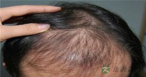 遗传性脱发怎么治 遗传性脱发怎么治