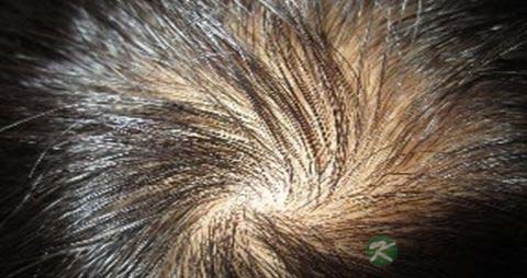 压力大脱发怎么办