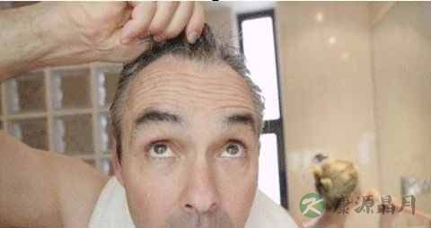 头顶脱发能恢复吗 头顶脱发能恢复吗