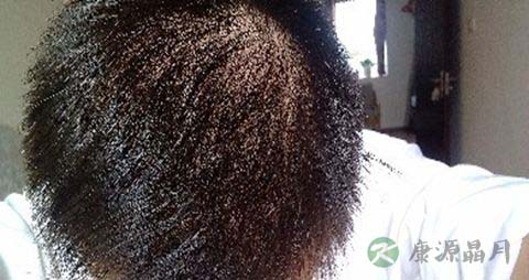 怎么治疗油脂性脱发 怎么治疗油脂性脱发