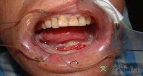 牙龈肿了吃什么