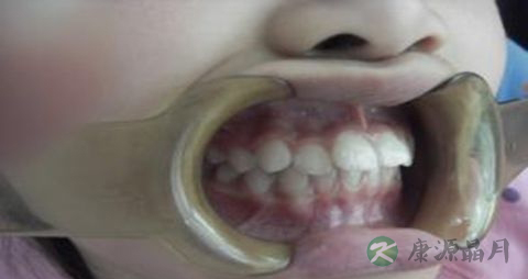 矫正牙齿后吃什么