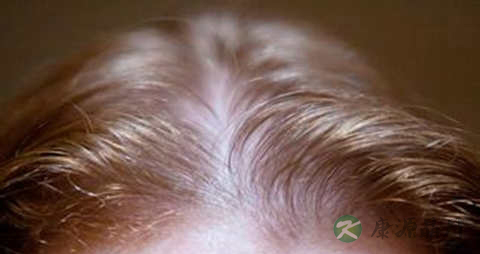 头发稀少脱发怎么办 头发稀少脱发怎么办