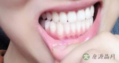 牙龈萎缩吃什么维生素