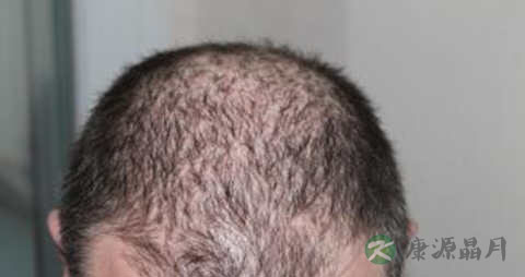 血虚脱发的症状 血虚脱发的症状