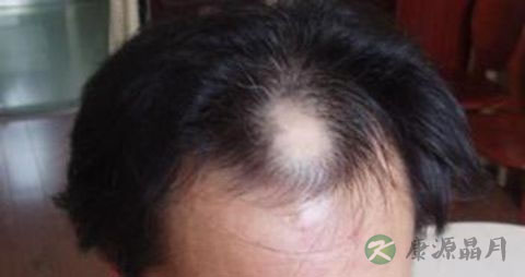 怎样防止脱发 怎样防止脱发