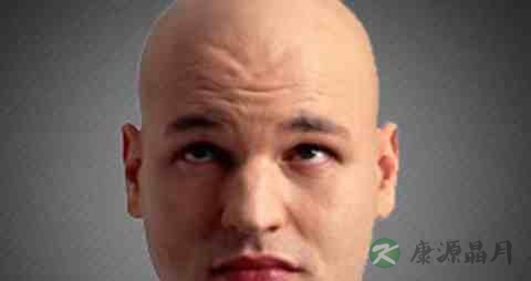 遗传性脱发能治疗吗