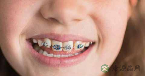 矫正牙齿的饮食 矫正牙齿的饮食
