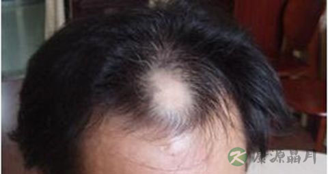 头上脱发怎么办 头上脱发怎么办