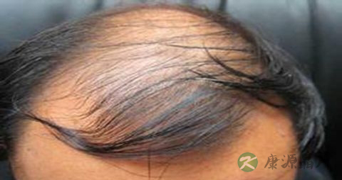 遗传性脱发怎么预防 遗传性脱发怎么预防