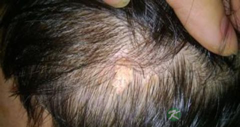 突然脱发严重什么原因 突然脱发严重什么原因