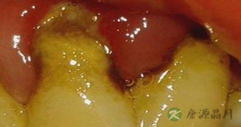 吃什么食物对牙龈好 吃什么食物对牙龈好