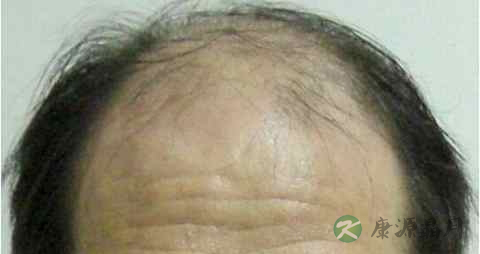 脱发白发原因及治疗