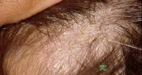 脂溢性脱发有哪些症状 脂溢性脱发有哪些症状
