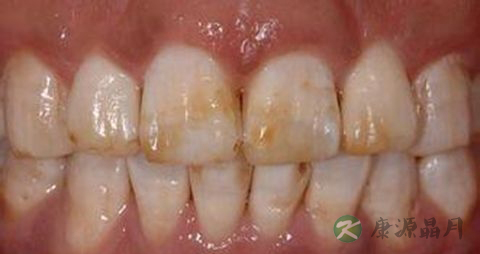 牙齿黄吃什么 牙齿黄吃什么