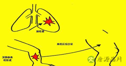 深静脉血栓吃什么药