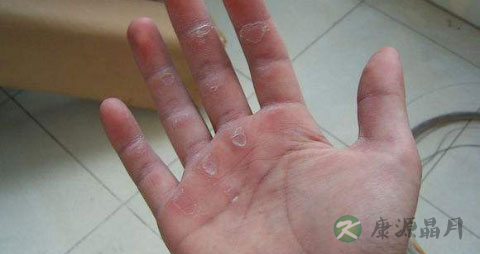 手掌掉皮是怎么回事