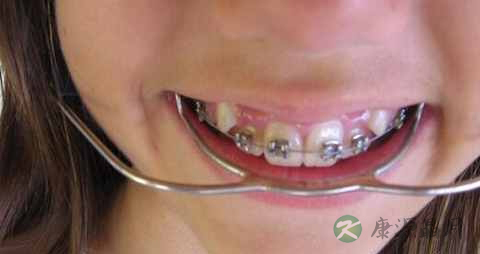 矫正牙齿的饮食 矫正牙齿的饮食