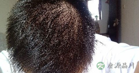 遗传脱发原因及治疗