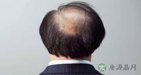 防止脱发的办法