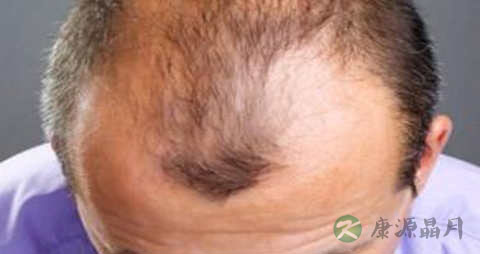 油脂性脱发怎么治疗 油脂性脱发怎么治疗