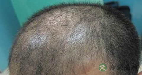 油脂性脱发怎么治疗 油脂性脱发怎么治疗