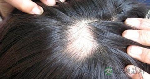 头顶脱发是什么原因 头顶脱发是什么原因