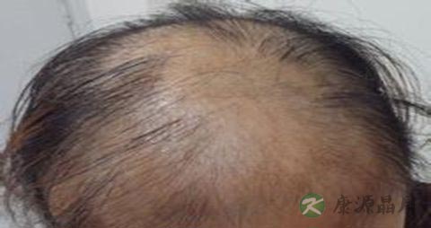 中医能治疗脱发吗