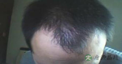 油脂性脱发治疗方法