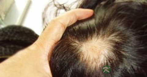 如何治疗油脂性脱发 如何治疗油脂性脱发