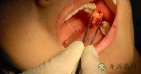 拔完牙齿吃什么好 拔完牙齿吃什么好